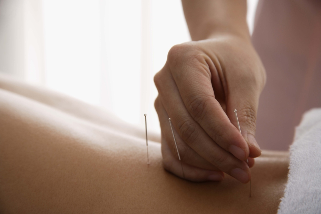 Picture of acupuncture needle being inserted into patient's low back