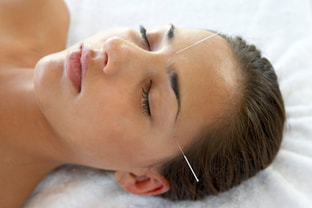 Picture of woman resting with acupuncture needles inserted